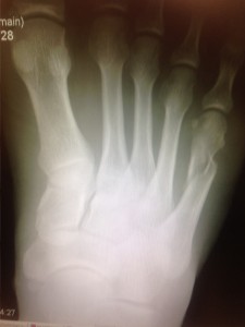 Metatarsal Foot Fracture